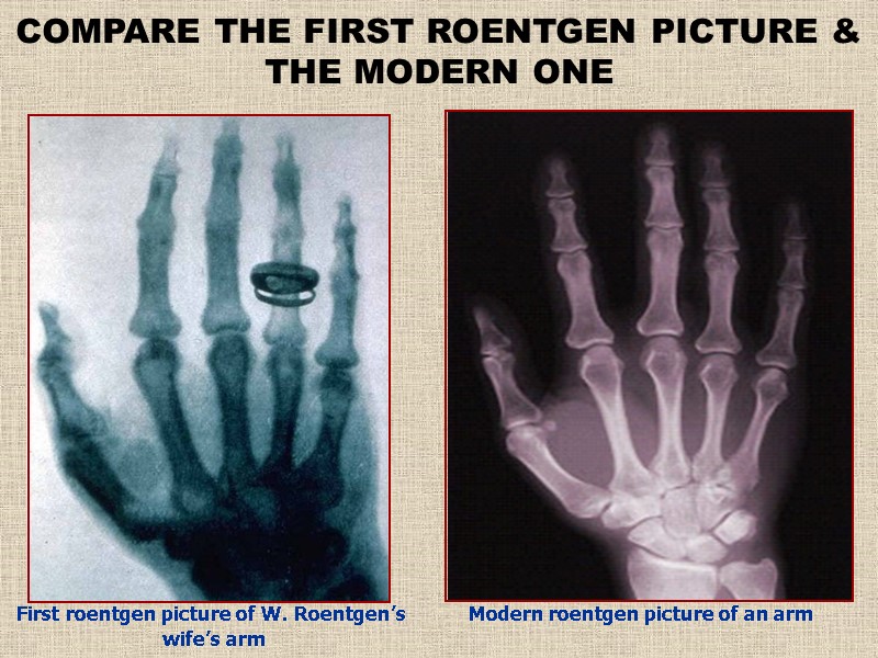 First roentgen picture of W. Roentgen’s  wife’s arm COMPARE THE FIRST ROENTGEN PICTURE